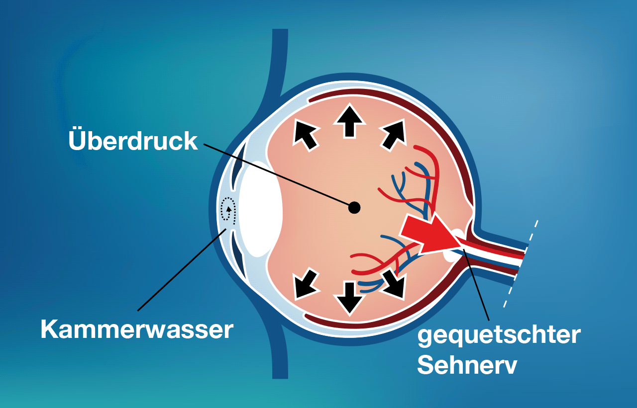 Glaukom - schematische Darstellung
