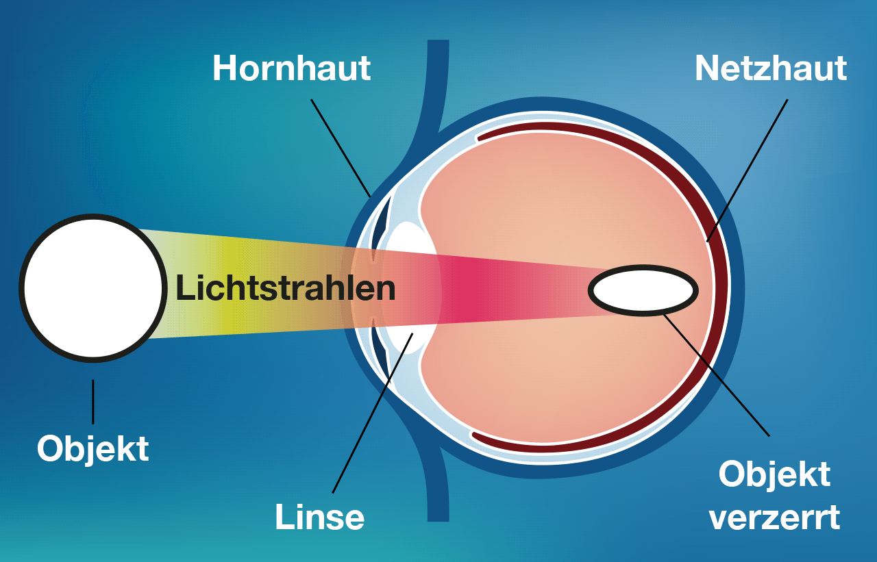 Hornhautverkrümmung Astigmatismus Grafik