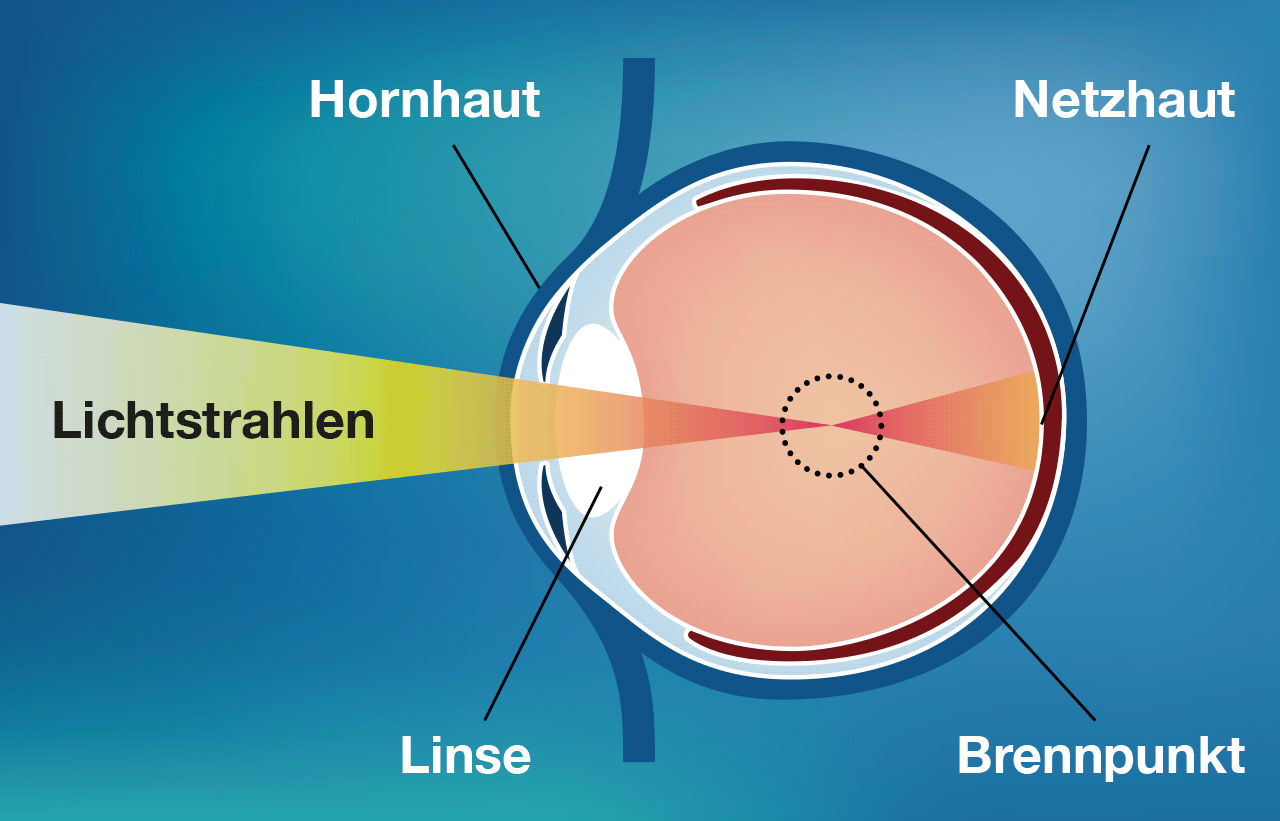 Kurzsichtigkeit Grafik