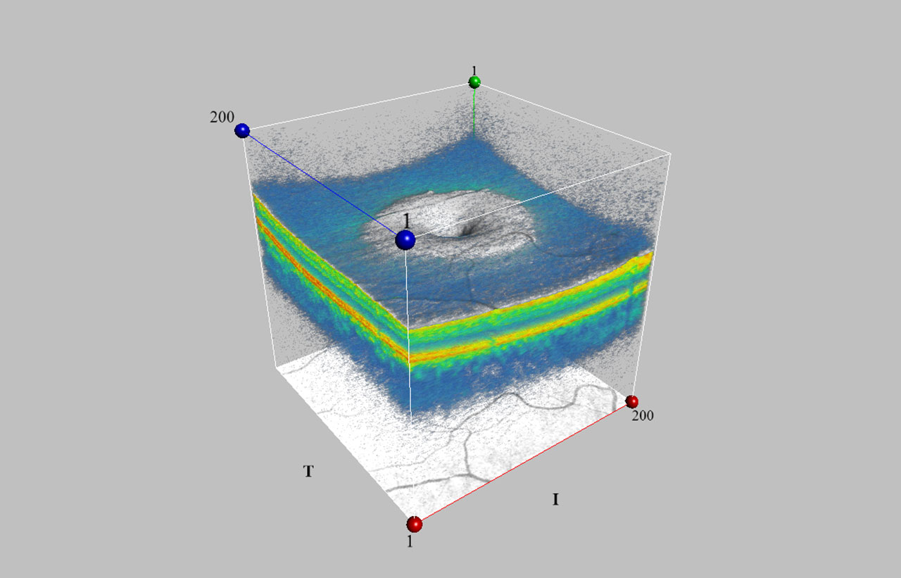 OCT Netzhautschichten