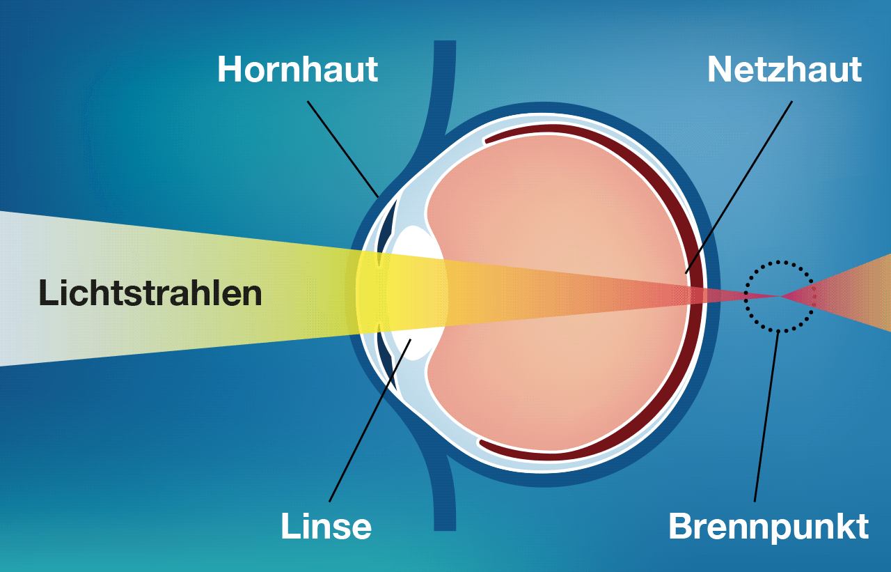 Weitsichtigkeit Grafik